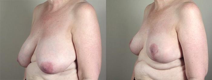 Breast Lift Case 538 Before & After View #2 | Paramus, New Jersey | Parker Center for Plastic Surgery