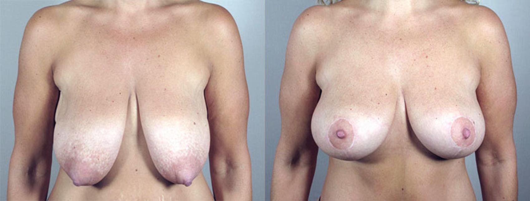 Breast Lift Case 548 Before & After View #1 | Paramus, New Jersey | Parker Center for Plastic Surgery