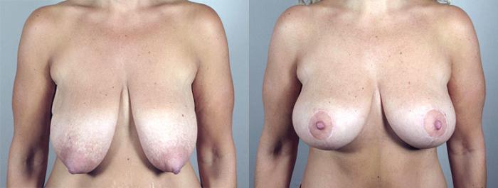 Breast Lift Case 548 Before & After View #1 | Paramus, New Jersey | Parker Center for Plastic Surgery