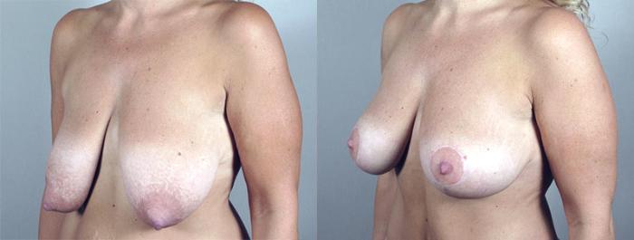 Breast Lift Case 548 Before & After View #2 | Paramus, New Jersey | Parker Center for Plastic Surgery