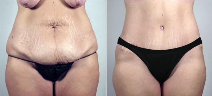 Breast Lift Case 548 Before & After View #3 | Paramus, New Jersey | Parker Center for Plastic Surgery