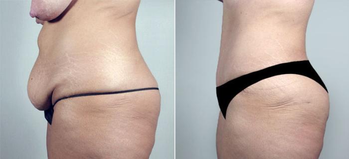 Breast Lift Case 548 Before & After View #4 | Paramus, New Jersey | Parker Center for Plastic Surgery