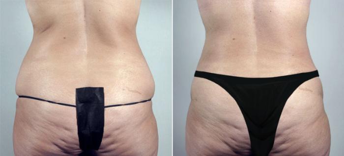 Breast Lift Case 548 Before & After View #5 | Paramus, New Jersey | Parker Center for Plastic Surgery