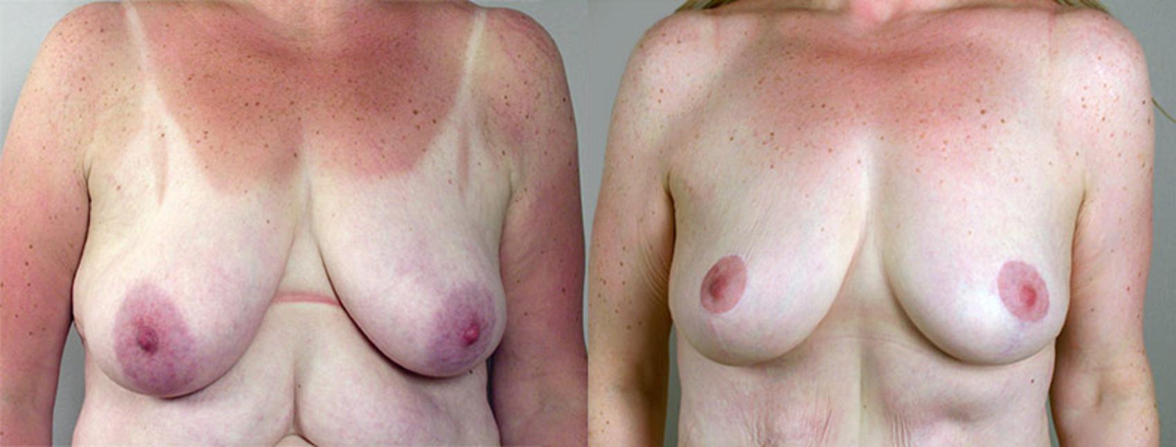 Breast Lift Case 550 Before & After View #1 | Paramus, New Jersey | Parker Center for Plastic Surgery