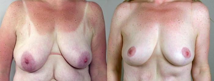 Breast Lift Case 550 Before & After View #1 | Paramus, New Jersey | Parker Center for Plastic Surgery