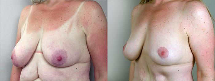 Breast Lift Case 550 Before & After View #2 | Paramus, New Jersey | Parker Center for Plastic Surgery