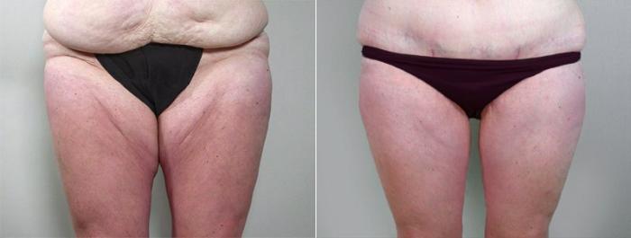 Breast Lift Case 550 Before & After View #3 | Paramus, New Jersey | Parker Center for Plastic Surgery