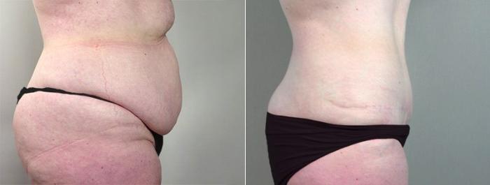 Breast Lift Case 550 Before & After View #4 | Paramus, New Jersey | Parker Center for Plastic Surgery
