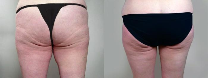 Breast Lift Case 550 Before & After View #5 | Paramus, New Jersey | Parker Center for Plastic Surgery