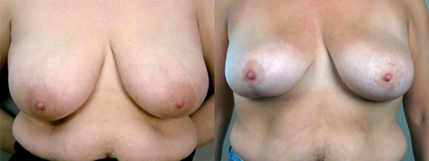 Breast Lift Case 551 Before & After View #1 | Paramus, New Jersey | Parker Center for Plastic Surgery