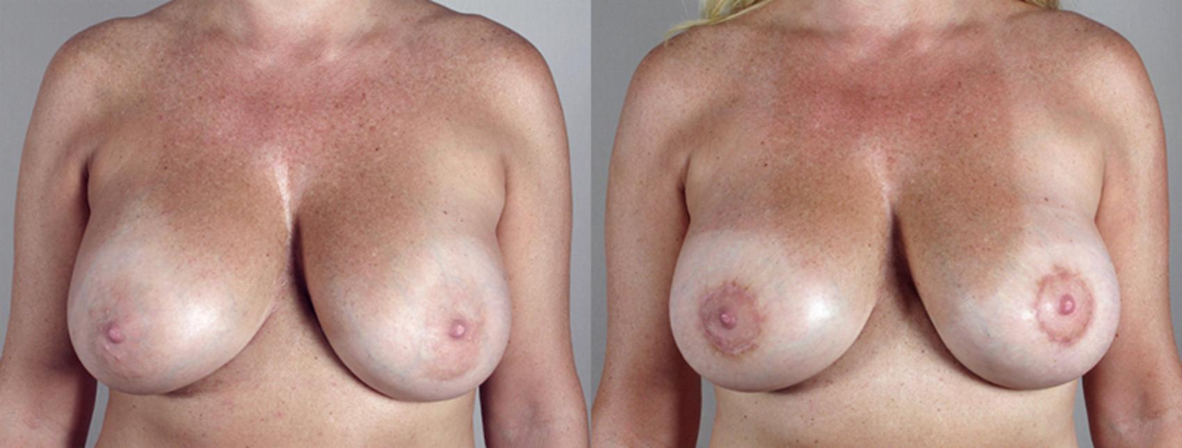 Breast Lift Case 552 Before & After View #1 | Paramus, New Jersey | Parker Center for Plastic Surgery