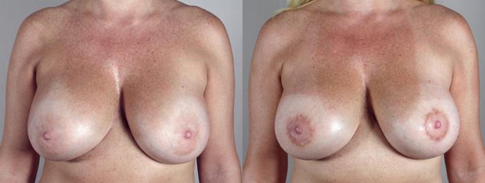 Breast Lift Case 552 Before & After View #1 | Paramus, New Jersey | Parker Center for Plastic Surgery