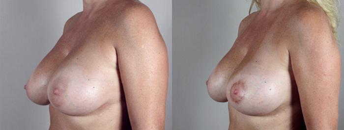 Breast Lift Case 552 Before & After View #2 | Paramus, New Jersey | Parker Center for Plastic Surgery