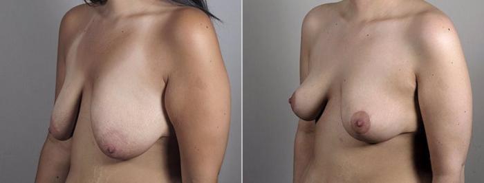 Breast Lift Case 554 Before & After View #2 | Paramus, New Jersey | Parker Center for Plastic Surgery