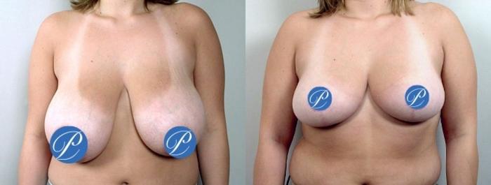 Breast Reduction Case 899 Before & After View #4 | Paramus, New Jersey | Parker Center for Plastic Surgery