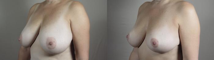 Breast Lift Case 968 Before & After 3/4 view right  | Paramus, New Jersey | Parker Center for Plastic Surgery