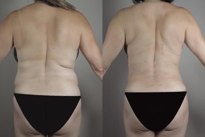 Breast Lift Case 968 Before & After Back | Paramus, New Jersey | Parker Center for Plastic Surgery