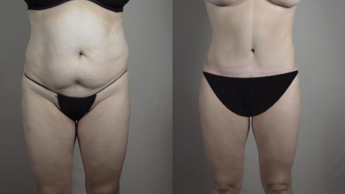 Breast Lift Case 968 Before & After Front Body  | Paramus, New Jersey | Parker Center for Plastic Surgery