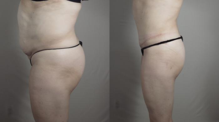Breast Lift Case 968 Before & After Right Side | Paramus, New Jersey | Parker Center for Plastic Surgery