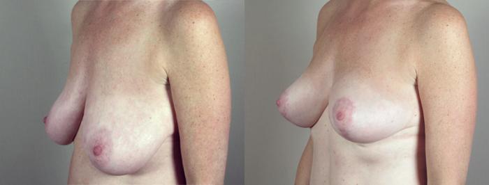 Breast Lift with Auto Aug Case 518 Before & After View #2 | Paramus, New Jersey | Parker Center for Plastic Surgery