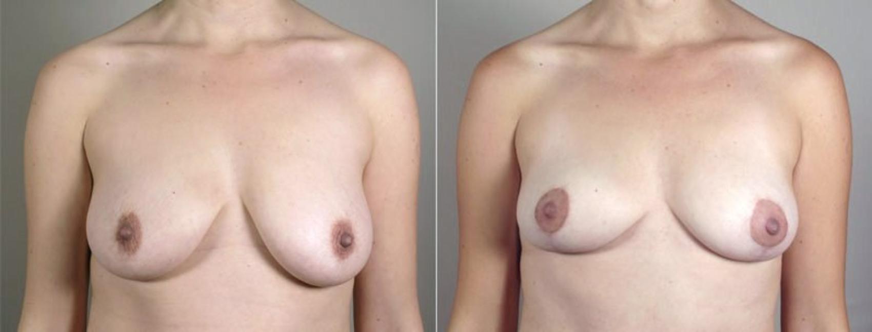Breast Lift with Auto Aug Case 519 Before & After View #1 | Paramus, New Jersey | Parker Center for Plastic Surgery