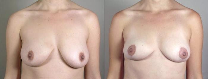 Breast Lift with Auto Aug Case 519 Before & After View #1 | Paramus, New Jersey | Parker Center for Plastic Surgery