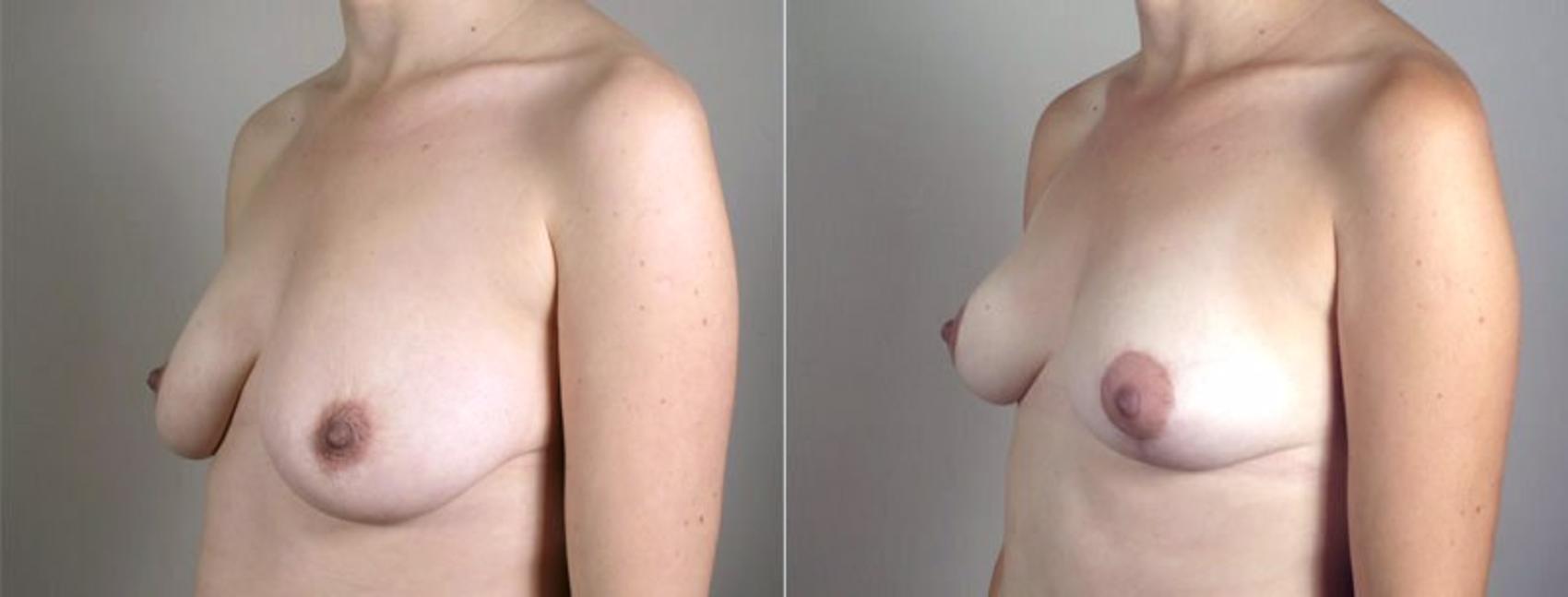 Breast Lift with Auto Aug Case 519 Before & After View #2 | Paramus, New Jersey | Parker Center for Plastic Surgery