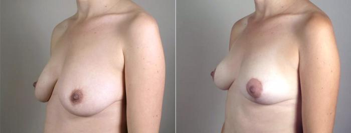Mommy Makeover Case 519 Before & After View #2 | Paramus, New Jersey | Parker Center for Plastic Surgery