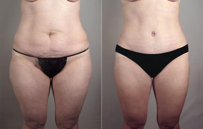 Mommy Makeover Case 519 Before & After View #3 | Paramus, New Jersey | Parker Center for Plastic Surgery