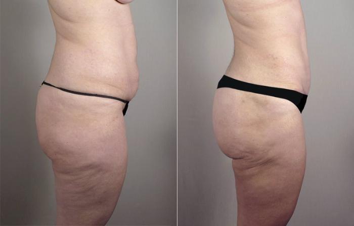 Mommy Makeover Case 519 Before & After View #4 | Paramus, New Jersey | Parker Center for Plastic Surgery