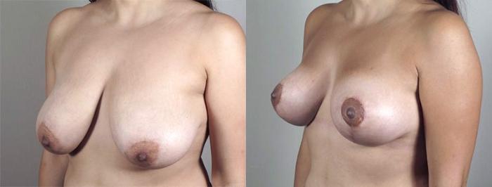Breast Lift with Auto Aug Case 520 Before & After View #2 | Paramus, New Jersey | Parker Center for Plastic Surgery