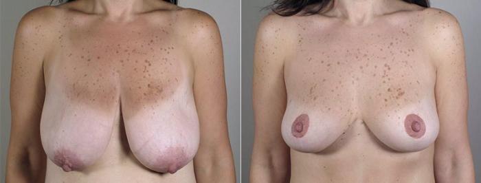 Breast Lift with Auto Aug Case 521 Before & After View #1 | Paramus, New Jersey | Parker Center for Plastic Surgery