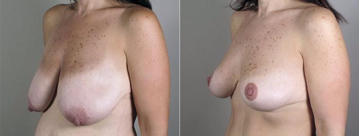 Breast Lift with Auto Aug Case 521 Before & After View #2 | Paramus, New Jersey | Parker Center for Plastic Surgery