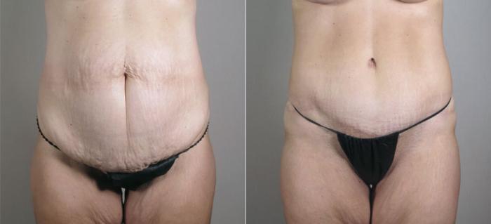 Breast Lift with Auto Aug Case 521 Before & After View #3 | Paramus, New Jersey | Parker Center for Plastic Surgery