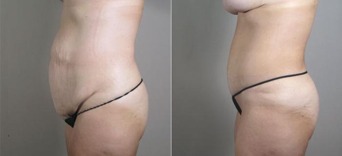 Breast Lift with Auto Aug Case 521 Before & After View #4 | Paramus, New Jersey | Parker Center for Plastic Surgery