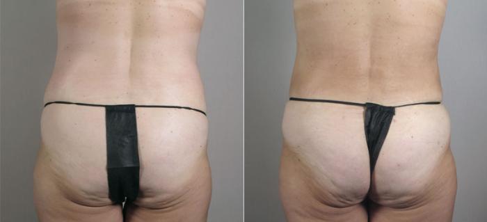Breast Lift with Auto Aug Case 521 Before & After View #5 | Paramus, New Jersey | Parker Center for Plastic Surgery