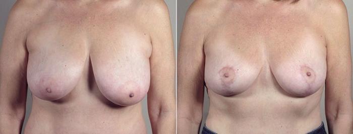 Breast Lift with Auto Aug Case 522 Before & After View #1 | Paramus, New Jersey | Parker Center for Plastic Surgery