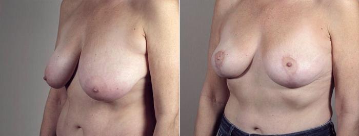 Liposuction Case 522 Before & After View #2 | Paramus, New Jersey | Parker Center for Plastic Surgery