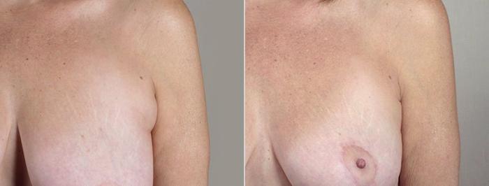 Liposuction Case 522 Before & After View #3 | Paramus, New Jersey | Parker Center for Plastic Surgery