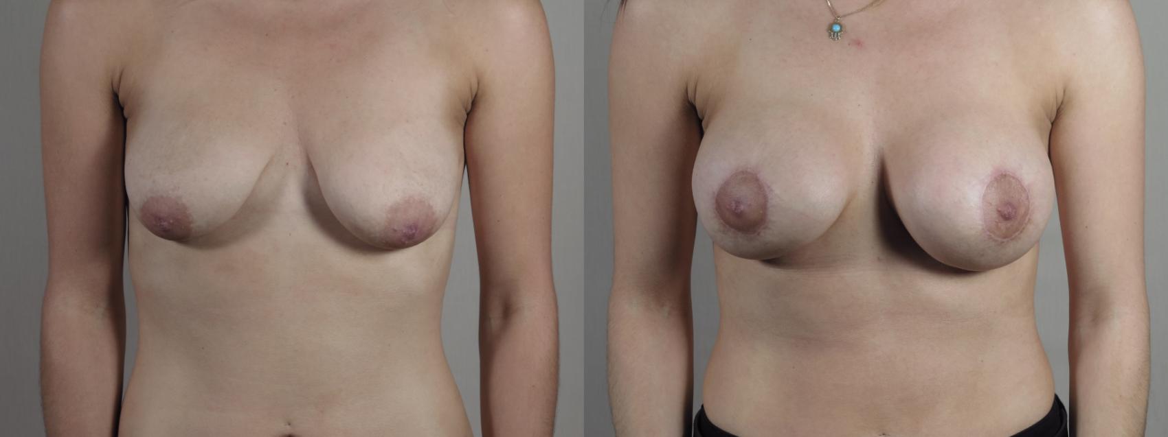 Breast Lift with Implants Case 1283 Before & After Front | Paramus, New Jersey | Parker Center for Plastic Surgery