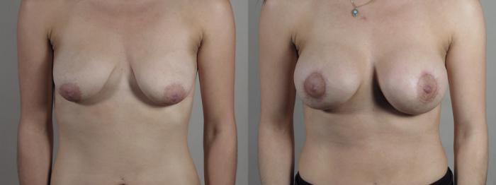 Breast Lift with Implants Case 1283 Before & After Front | Paramus, New Jersey | Parker Center for Plastic Surgery
