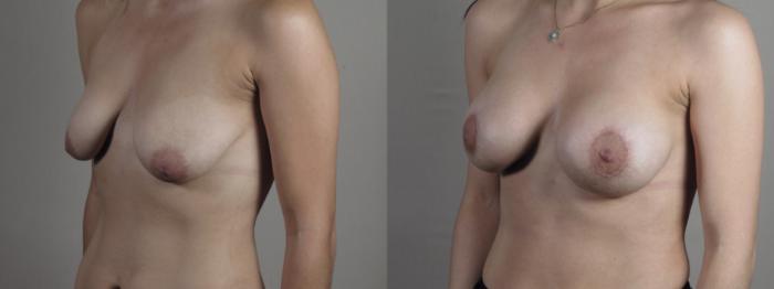 Breast Lift with Implants Case 1283 Before & After Left Oblique | Paramus, New Jersey | Parker Center for Plastic Surgery