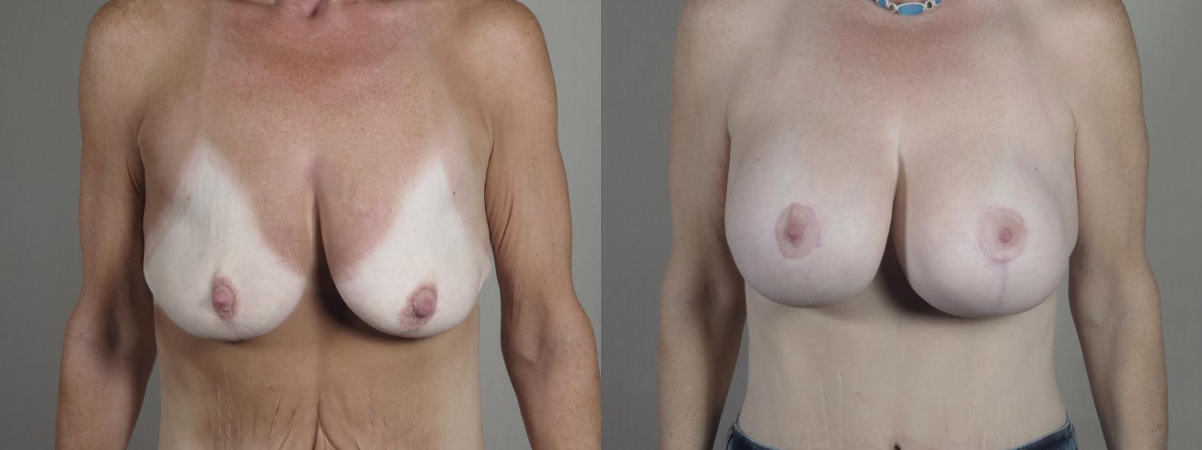 Breast Lift with Implants Case 1297 Before & After Front | Paramus, New Jersey | Parker Center for Plastic Surgery