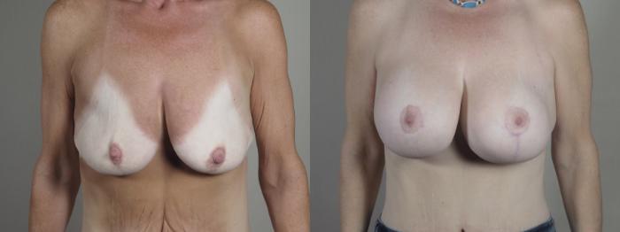 Breast Lift with Implants Case 1297 Before & After Front | Paramus, New Jersey | Parker Center for Plastic Surgery