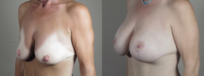 Breast Lift with Implants Case 1297 Before & After Left Oblique | Paramus, New Jersey | Parker Center for Plastic Surgery