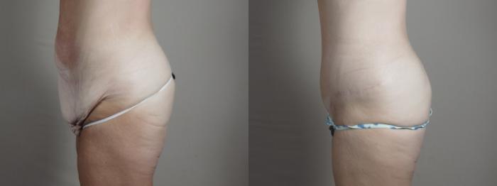 Breast Lift with Implants Case 1297 Before & After Left Side | Paramus, New Jersey | Parker Center for Plastic Surgery