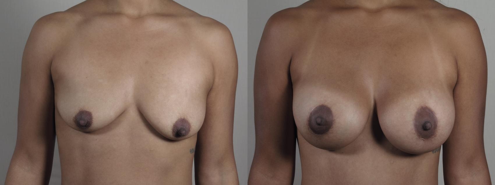 Breast Asymmetry Case 1299 Before & After Front | Paramus, New Jersey | Parker Center for Plastic Surgery