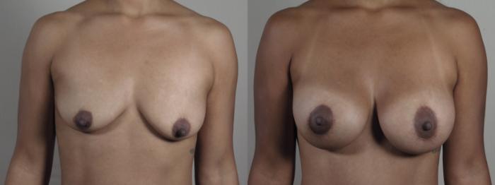 Breast Asymmetry Case 1299 Before & After Front | Paramus, New Jersey | Parker Center for Plastic Surgery