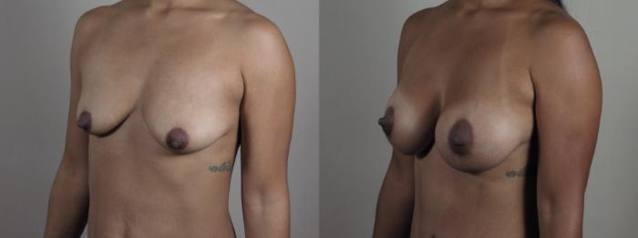 Breast Asymmetry Case 1299 Before & After Left Oblique | Paramus, New Jersey | Parker Center for Plastic Surgery