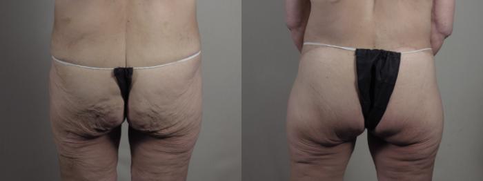Breast Lift with Implants Case 1301 Before & After Back | Paramus, New Jersey | Parker Center for Plastic Surgery
